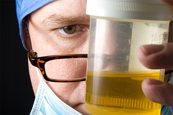 What Causes a False Positive for Alcohol on Urine Screens?