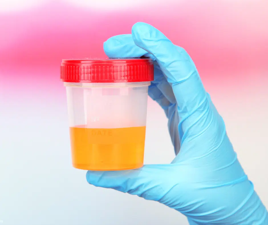 How Urine Alcohol Tests Detect Addiction and Abuse